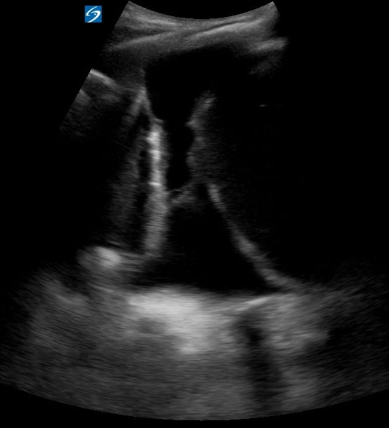 Pleural Effusion + Consolidation4 - Video