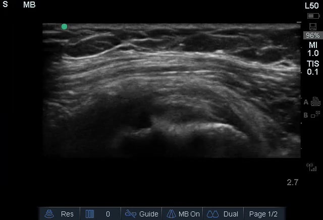 Massive Rotator Cuff Tear1 (Long Axis) - Video