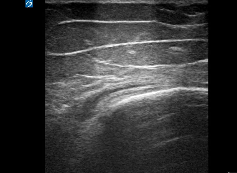 Pes Anserine Bursitis2 - Video
