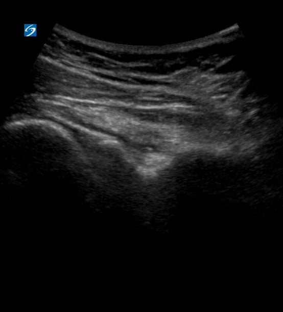 Shoulder Post Reduction3 (Posterior View) - Video