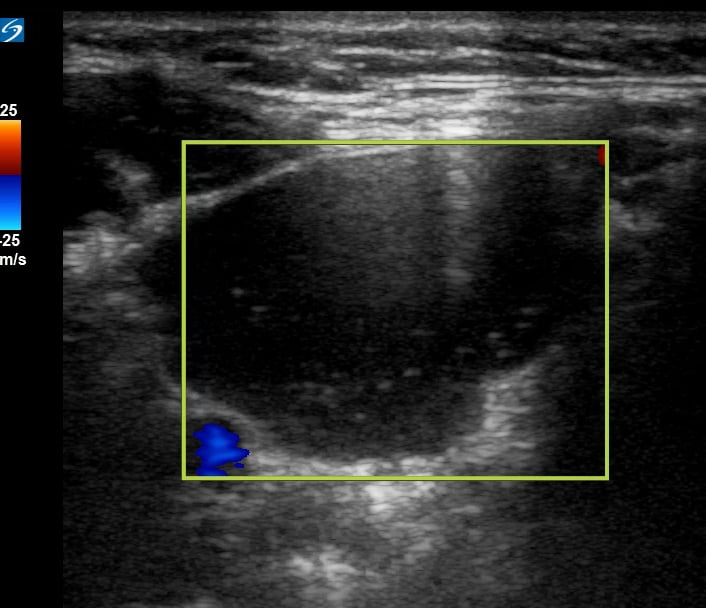 Branchial Cleft Cyst3 (6Wk Old) (Color) - Video