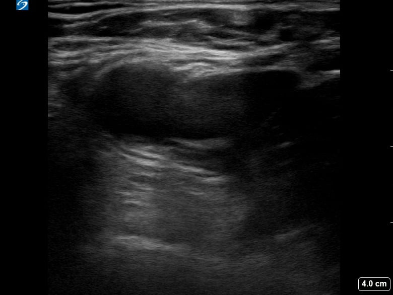 Femoral (-) Dvt7 (At Saphenous Junction) - Video