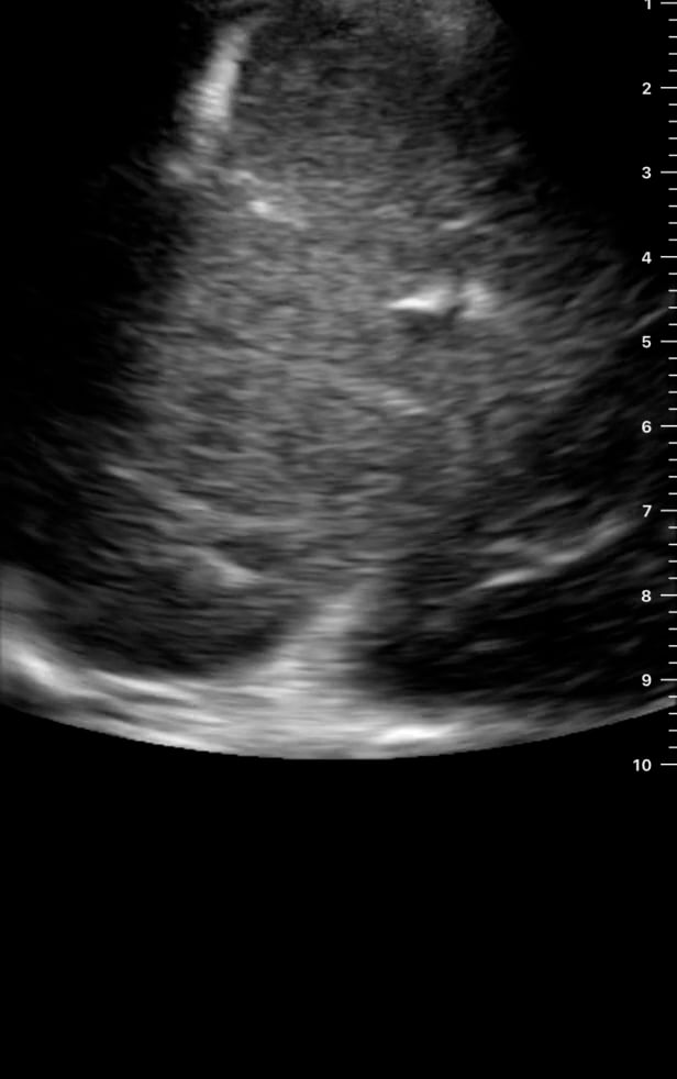 Ruq (-) Tb Ascites1 - Video