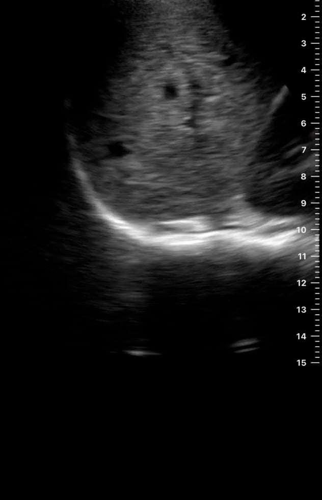 Ruq (-) Tb Ascites2 - Video