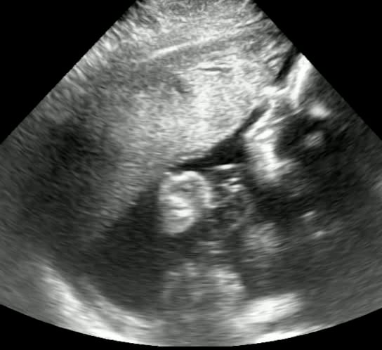 Amniotic Fluid by Deep Vertical Pocket: Present