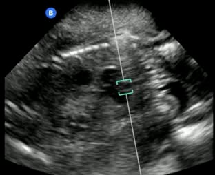 # of Gestations: Singleton
