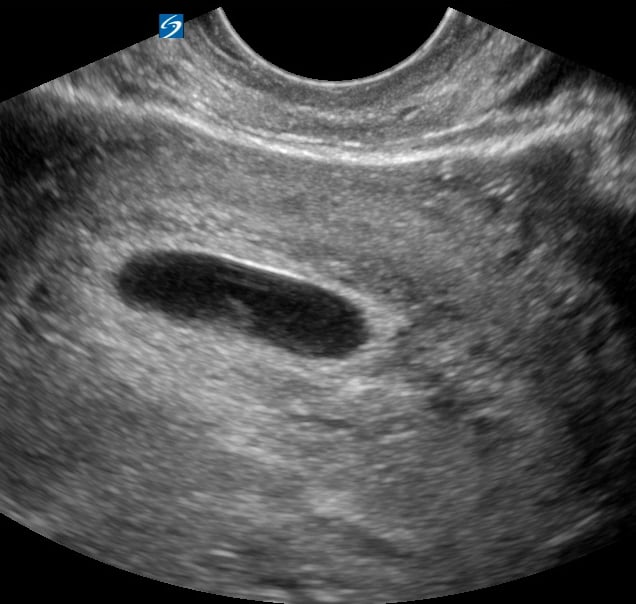 1St Tri Iup1 - Video