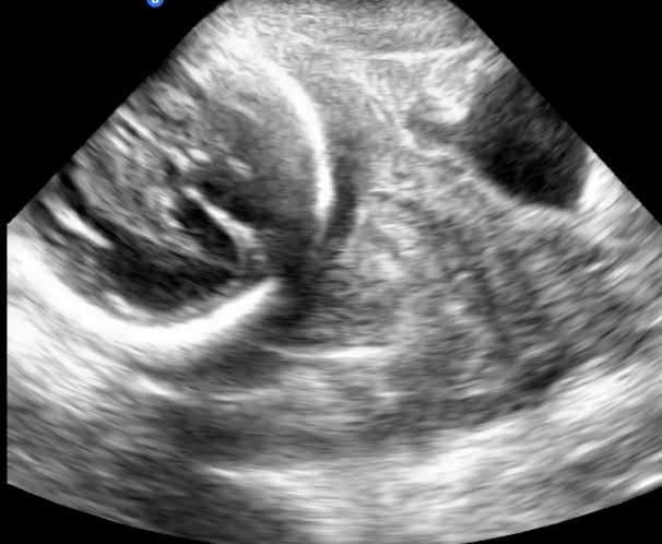 # of Gestations: Singleton