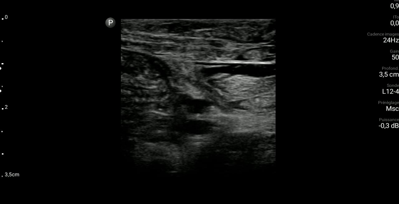 Popliteal Dvt1 - Video