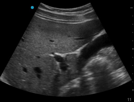 Normal Cbd1 (With Portal Vein With Mickey Mouse Sign) - Video