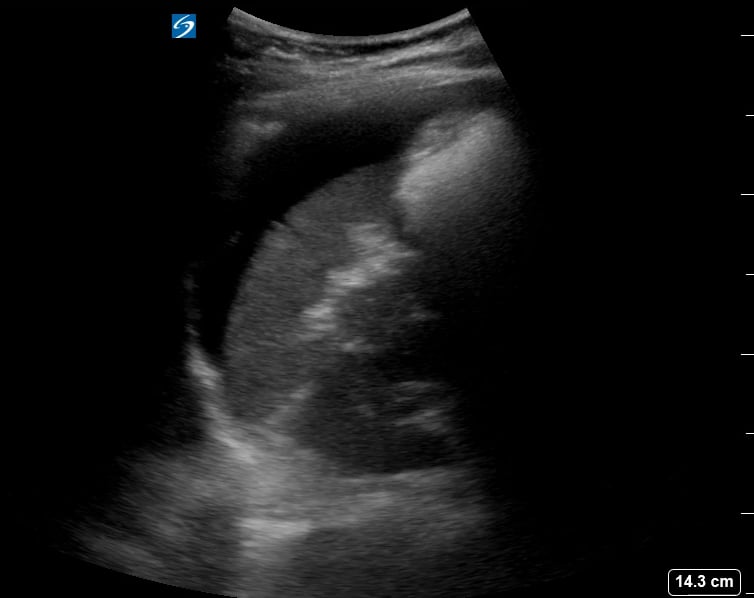 Luq Free Fluid3 (Ruptured Ectopic Pregnancy) - Video