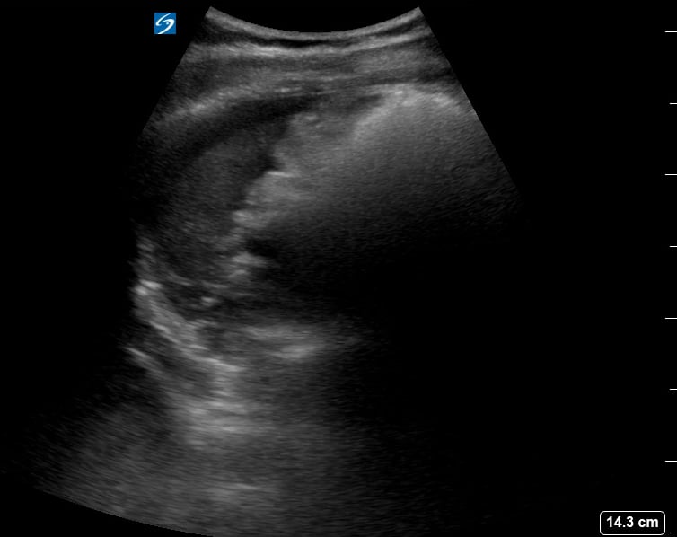 Luq Free Fluid1 (Ruptured Hemorrhagic Cyst) - Video