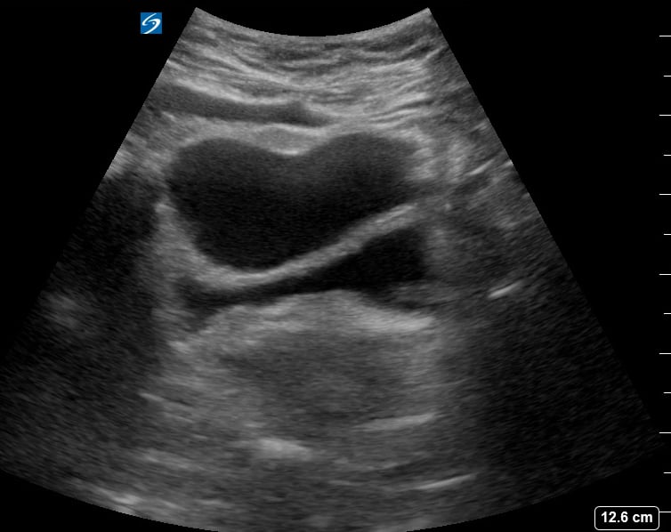 Pelvic Free Fluid7 (Ruptured Hemorrhagic Ovarian Cyst) - Video