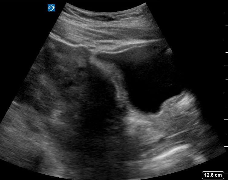 Pelvic Free Fluid3 (Ruptured Hemorrhagic Ovarian Cyst) - Video