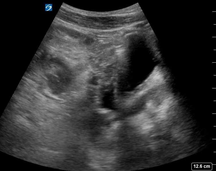 Pelvic Free Fluid1 (Ruptured Hemorrhagic Ovarian Cyst) - Video