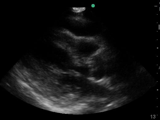 Plax Pericardial Effusion8 (Cardiac Tamponde Rv Diastolic Collapse) - Video