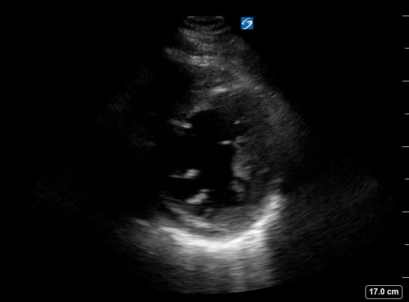 Psax Depressed Ef7 (Ef~35%