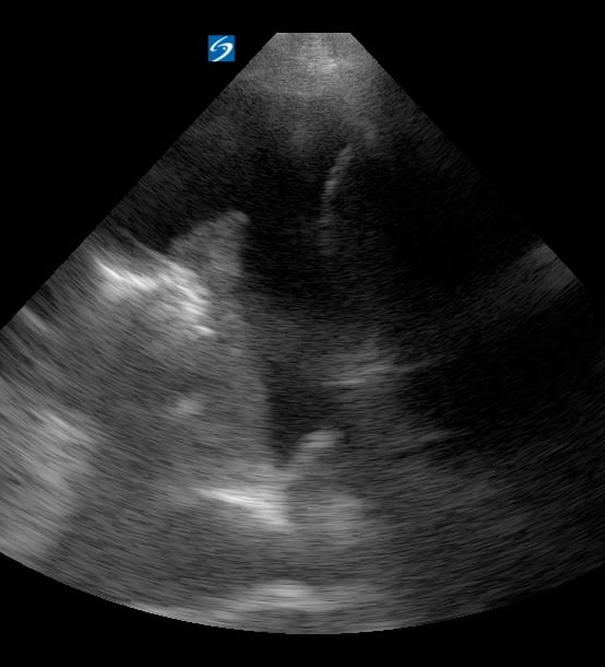 Pleural Effusion + Atelectasis5 (+Spine Sign) - Video